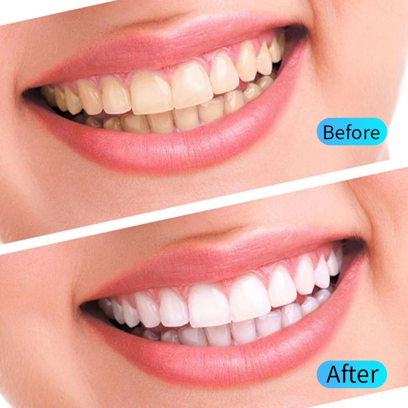Teeth Whitening Gel Kit Oral H - Teeth Whitening Opalescence review and price
