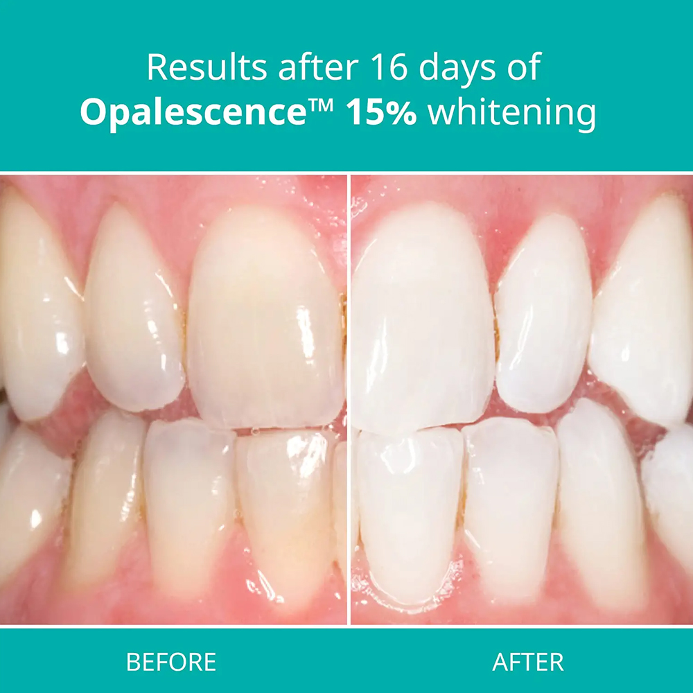 Opalescence Professional White - Teeth Whitening Opalescence review and price