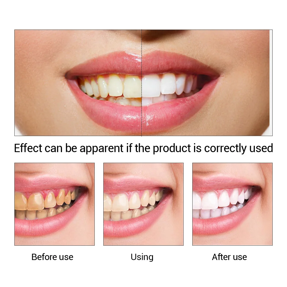 FTEENPLY Teeth Whitening Essen - Teeth Whitening Singapore review and price