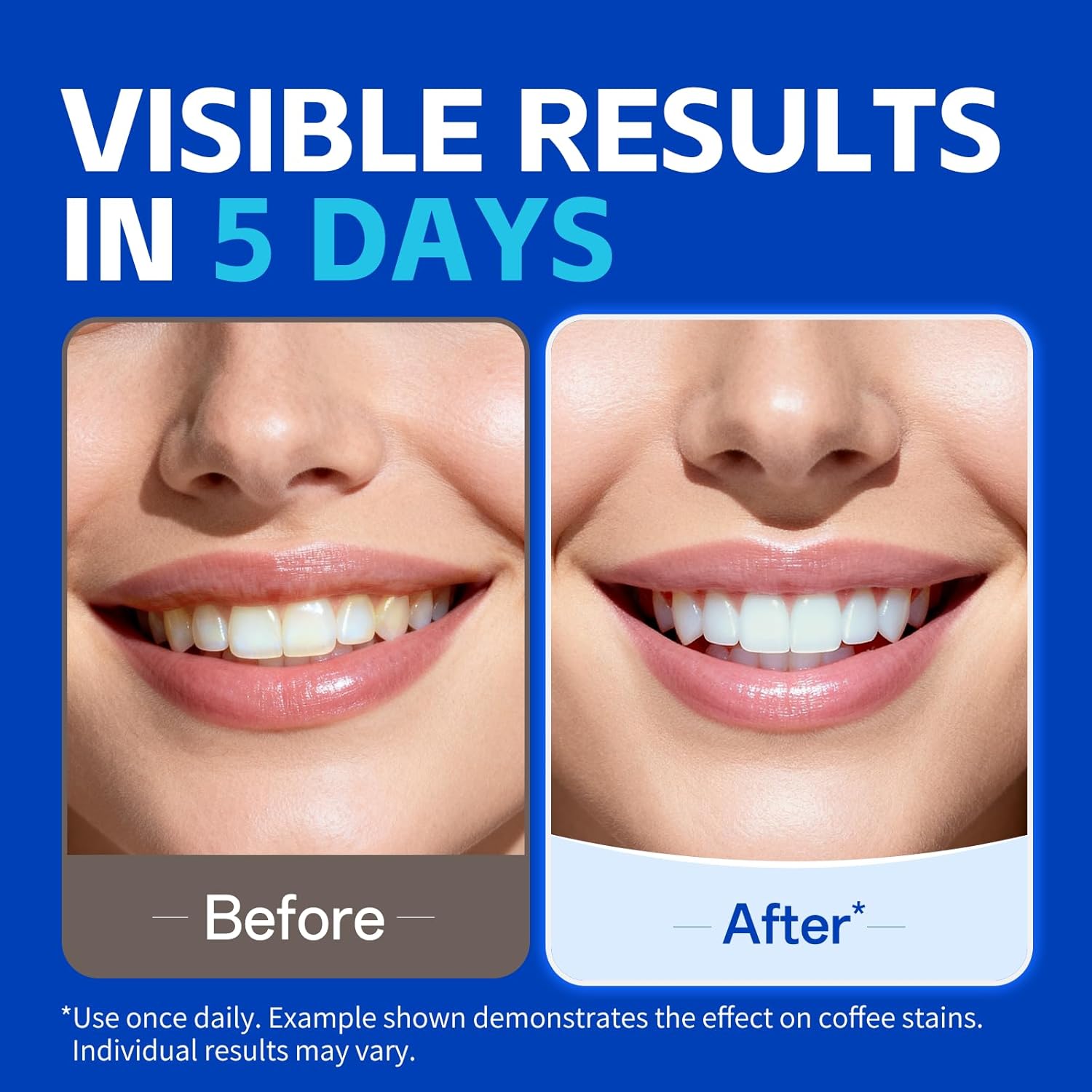 1/7 Pairs Teeth Whitening Stri - Teeth Whitening Strips Crest review and price