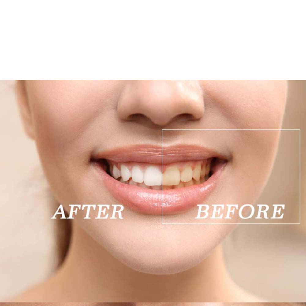 Top Quality Peroxide Teeth Whi - Teeth Whitening Kit review and price