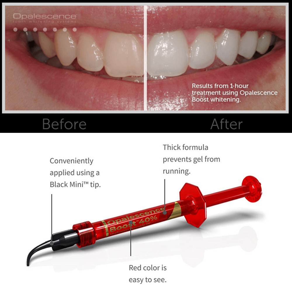 Ultradent Opalescence Boost PF - Teeth Whitening Opalescence review and price